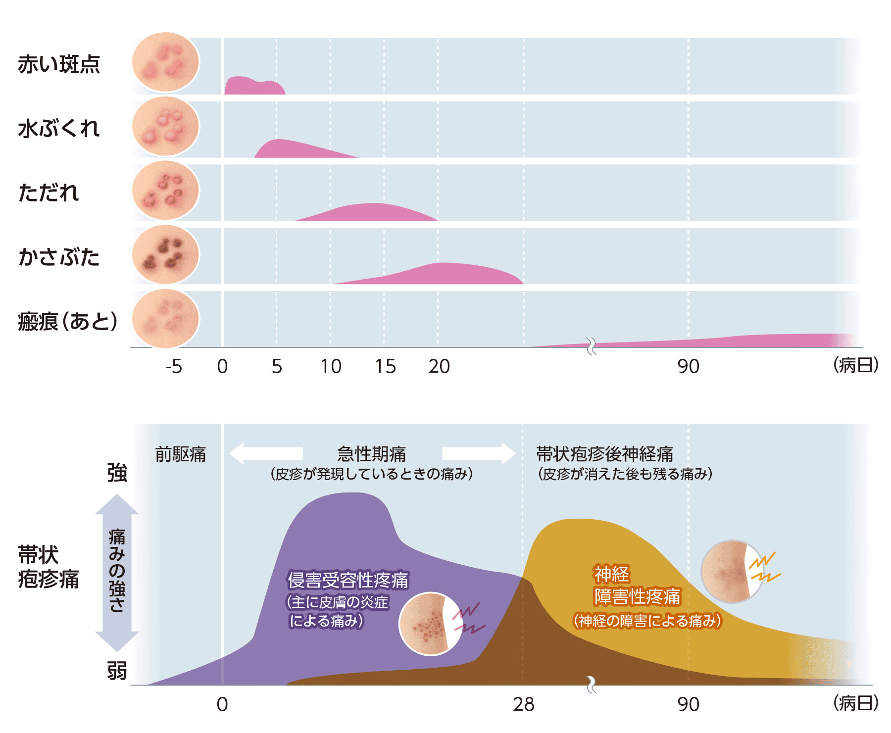 帯状疱疹の痛みのピークはいつまで？激痛の正体と後遺症を防ぐ全知識