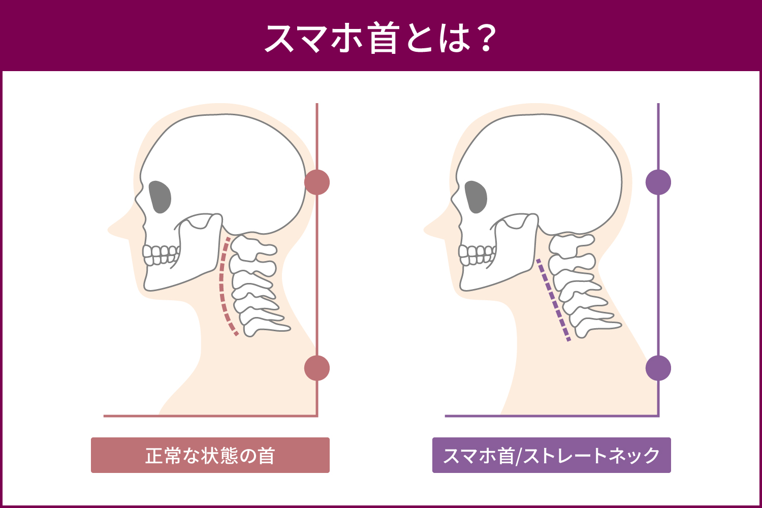 顎下のたるみが消えない原因とは？自力で治す筋トレと美容医療の最新比較