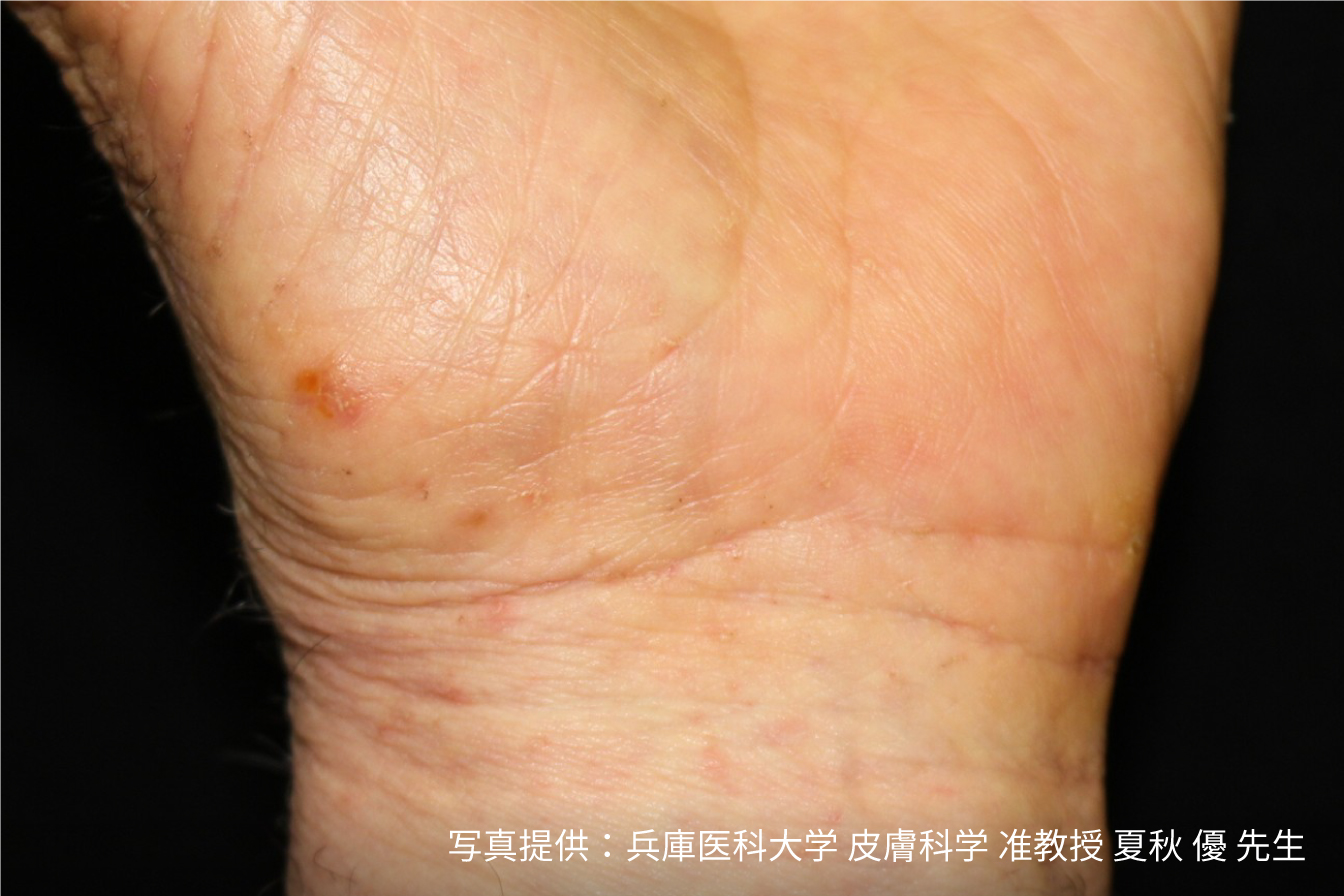 ダニ刺されか画像で判明！赤い腫れの正体と2026年最新の対処法