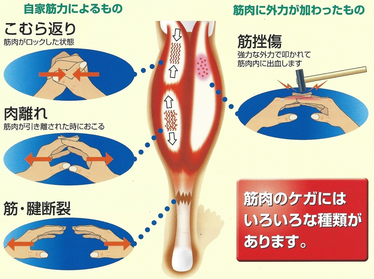 足がつると肉離れの決定的な違い！見分け方と正しい応急処置