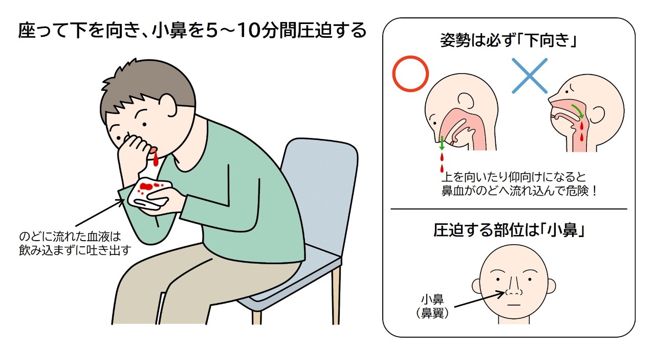 鼻血の正しい止め方完全ガイド！危険なNg処置と病院受診の目安