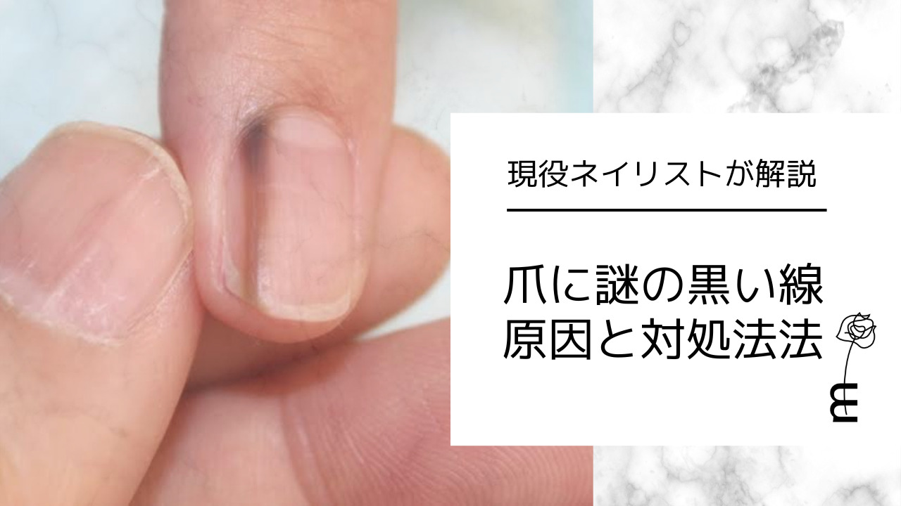 爪の黒い線は病気のサイン？原因とメラノーマの見分け方を徹底解説
