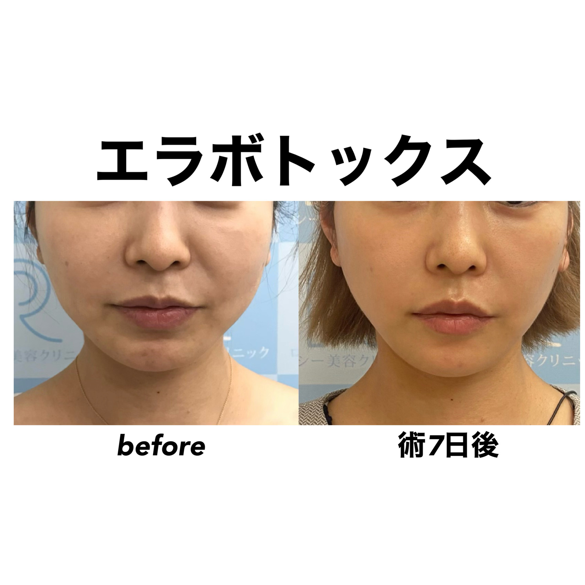 エラボトックスのダウンタイム徹底検証｜腫れや笑いにくさの真相と対策