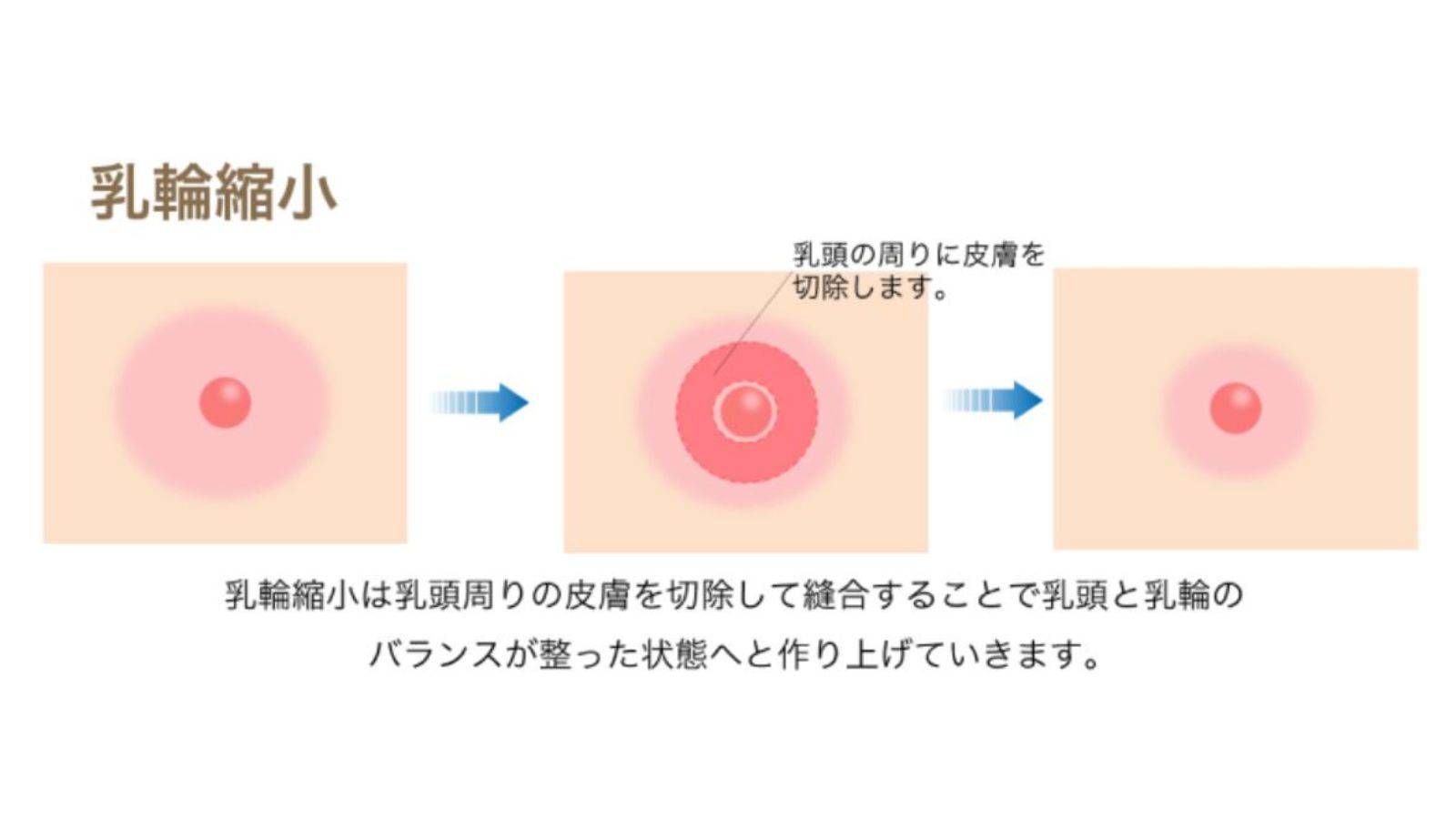 乳輪の大きさ平均は何センチ？肥大化の原因と自力ケアの誤解を徹底解明