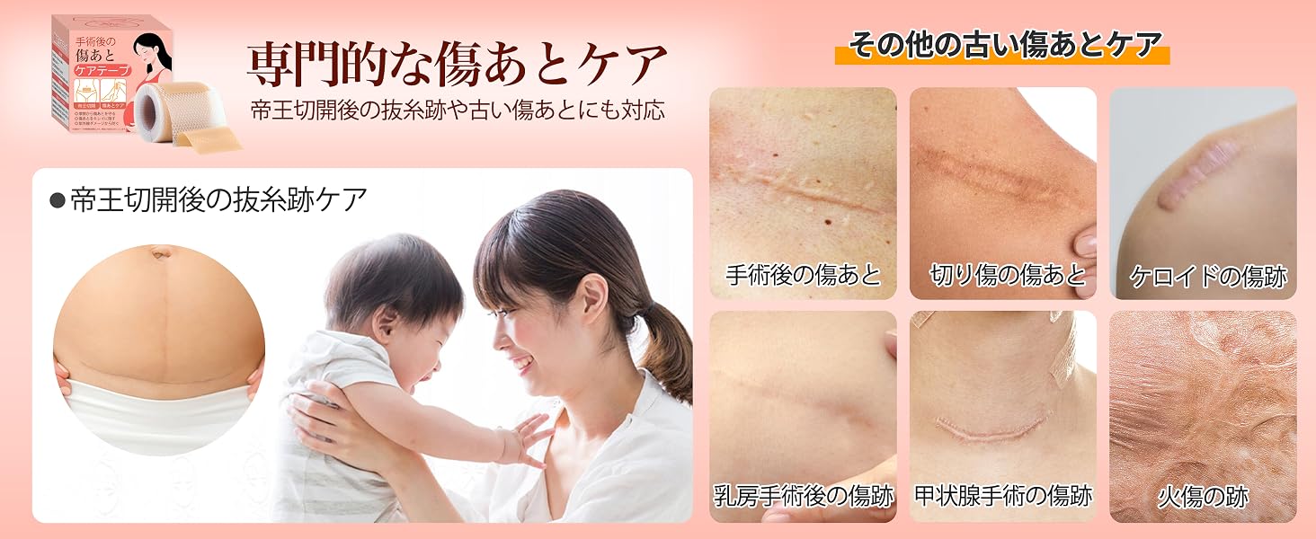 帝王切開の傷跡が痒い・盛り上がる？ケロイドの正体と最新治療法