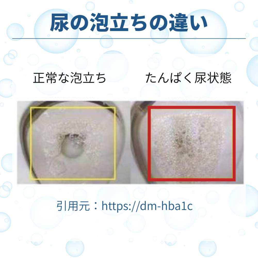 尿の泡立ちや甘酸っぱい匂いは危険？糖尿病の初期サインと放置リスクの真相