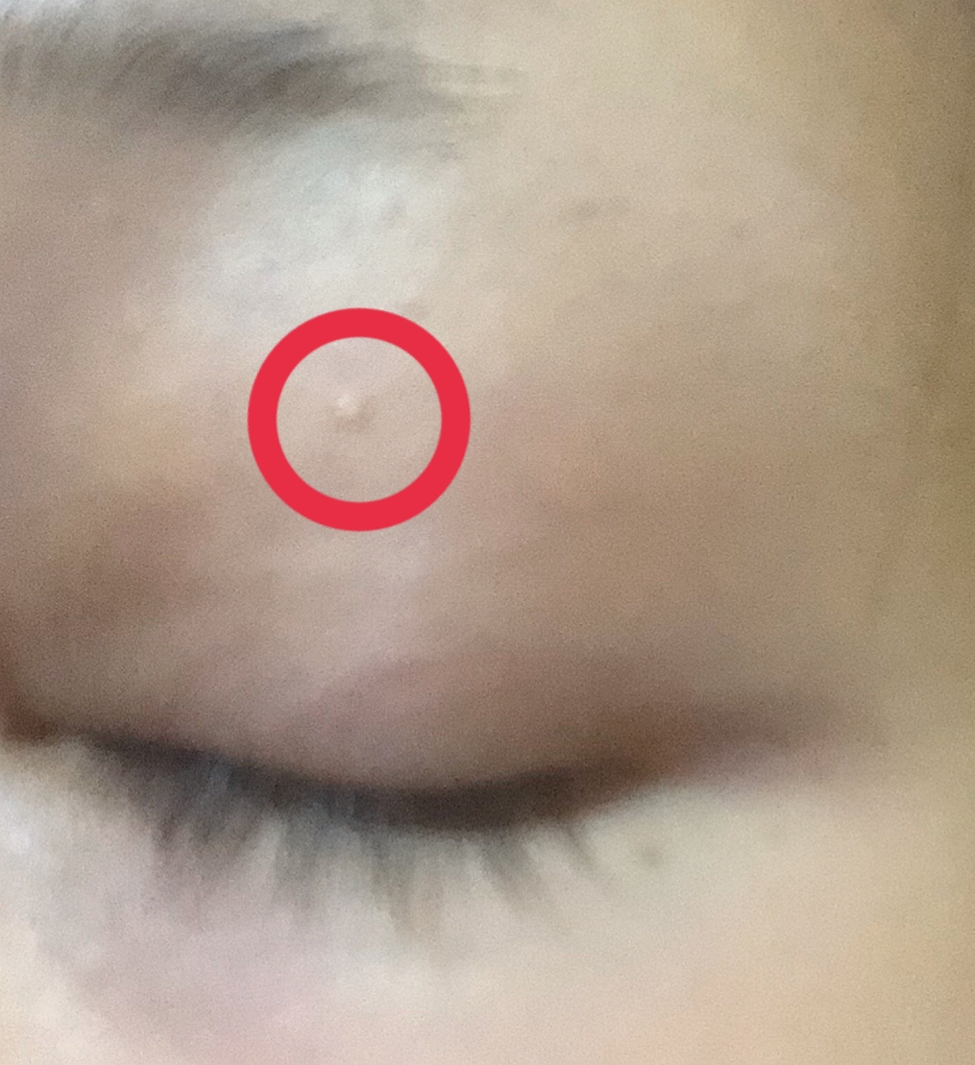 まぶたの小さいできものは何？痛くない白いポツポツの原因と治し方