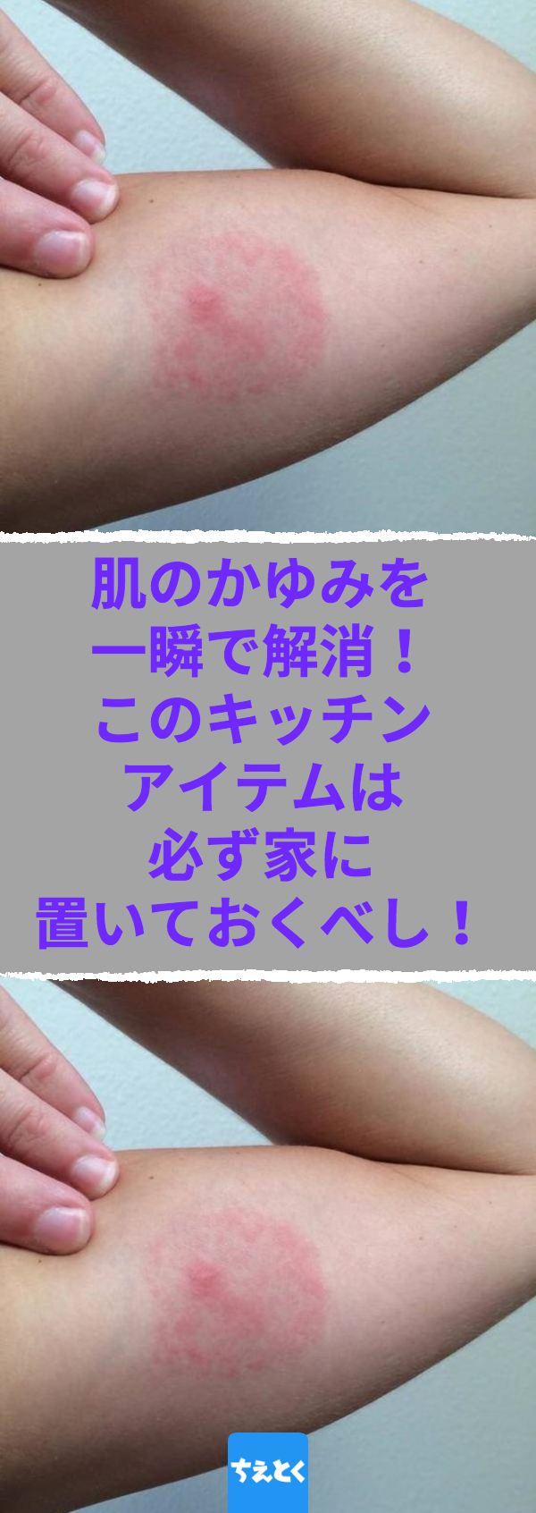 蚊のかゆみを一瞬で止める裏ワザ！温熱療法と家にある物での緊急対処法