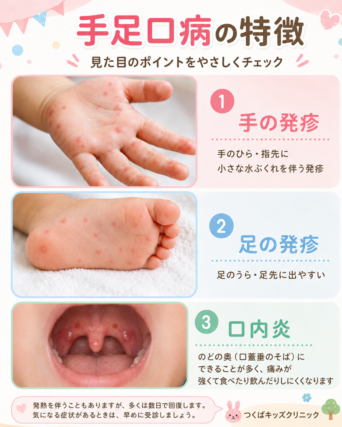手足口病の登園はいつから？発疹や解熱後の基準と許可証のリアル