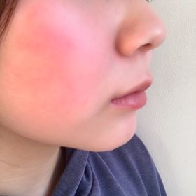 「暖房で顔が赤くなる」原因と対策！オフィスですぐ冷ます緊急ケア