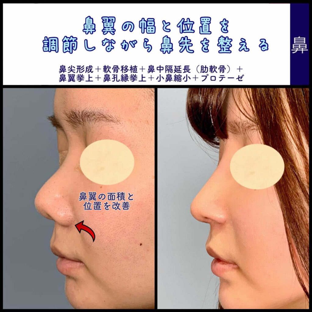 鼻を高くする方法の嘘と真実｜自力ケアと整形の決定打【2026年最新】