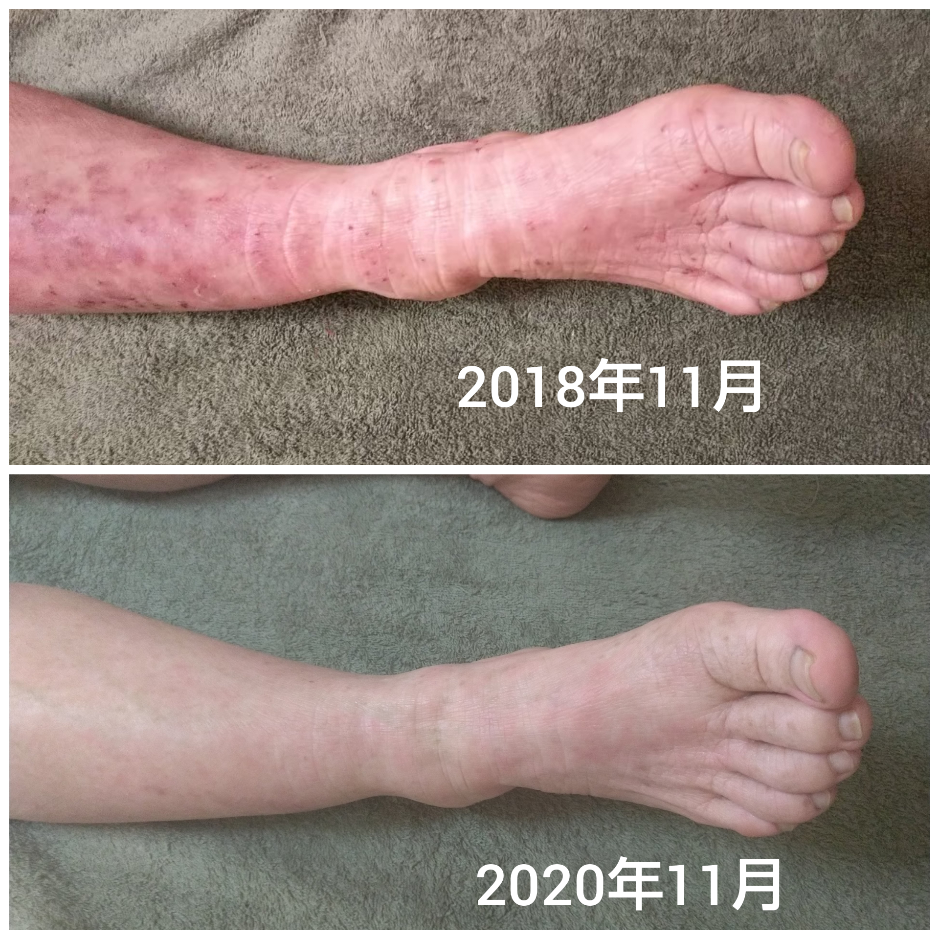 薬を塗ってもアトピーが治らないのはなぜ？悪化の真相と2026年最新治療