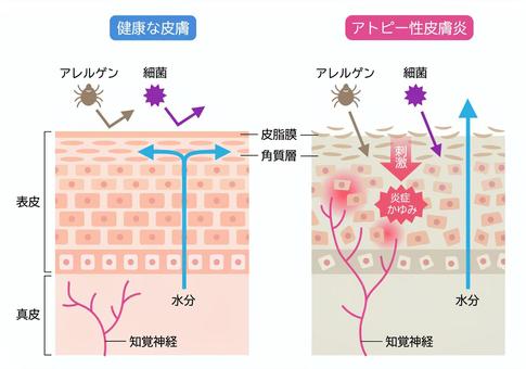 汗をかく季節の悪夢に終止符？アトピーの痒みを引き起こす「真犯人」が解明、カビ対策が治療の最前線へ