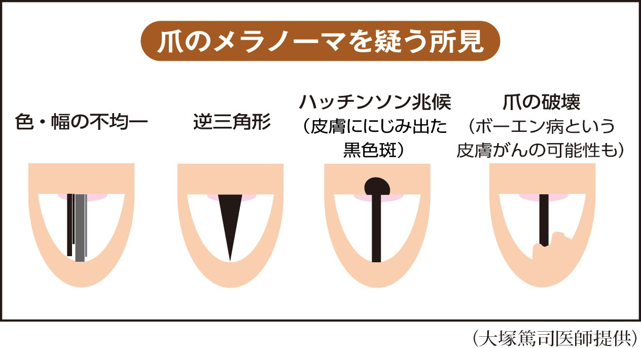 爪の黒い線はがんの兆候？ほくろとの見分け方と危険なサインを徹底解説
