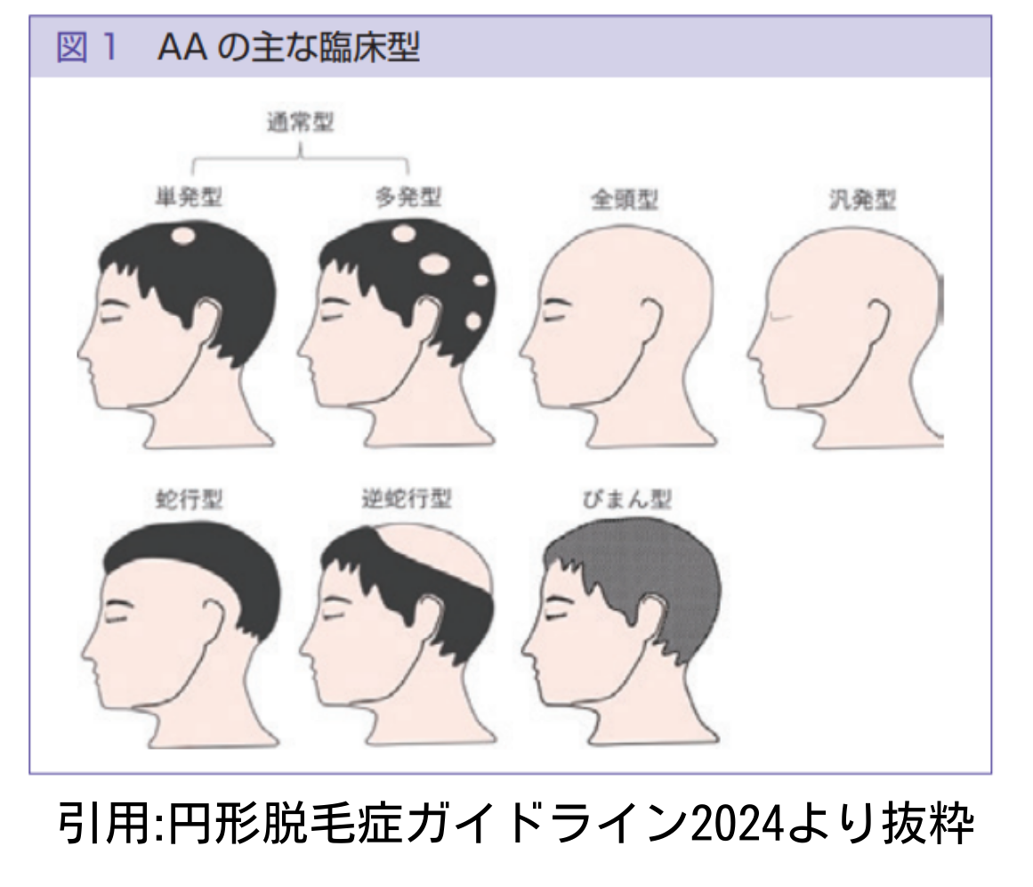 突然抜ける円形脱毛症の真因と治る前兆｜2026年最新治療の全貌