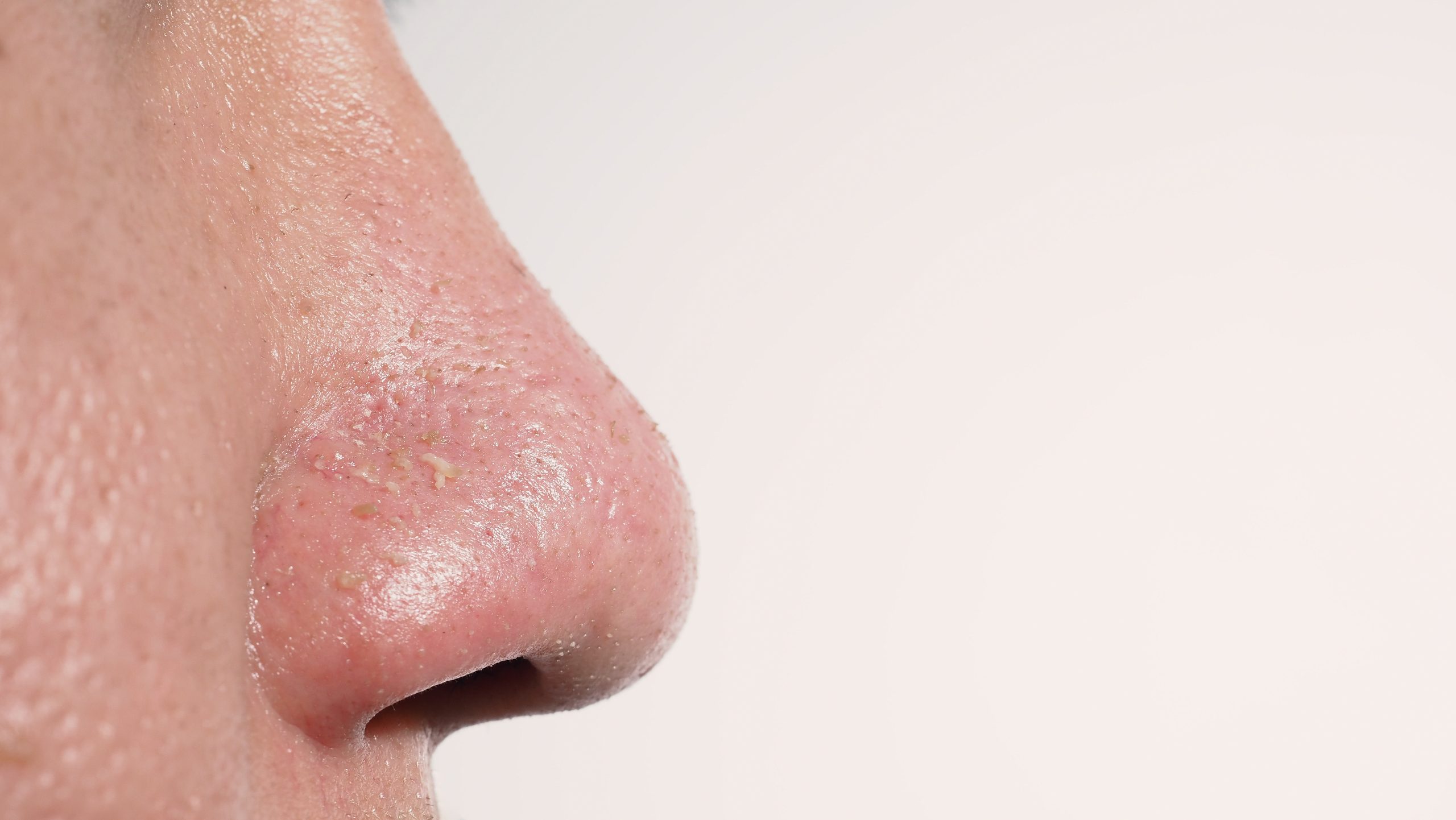 角栓がない人の秘密とは？生まれつきの体質と毛穴レス習慣を徹底解明