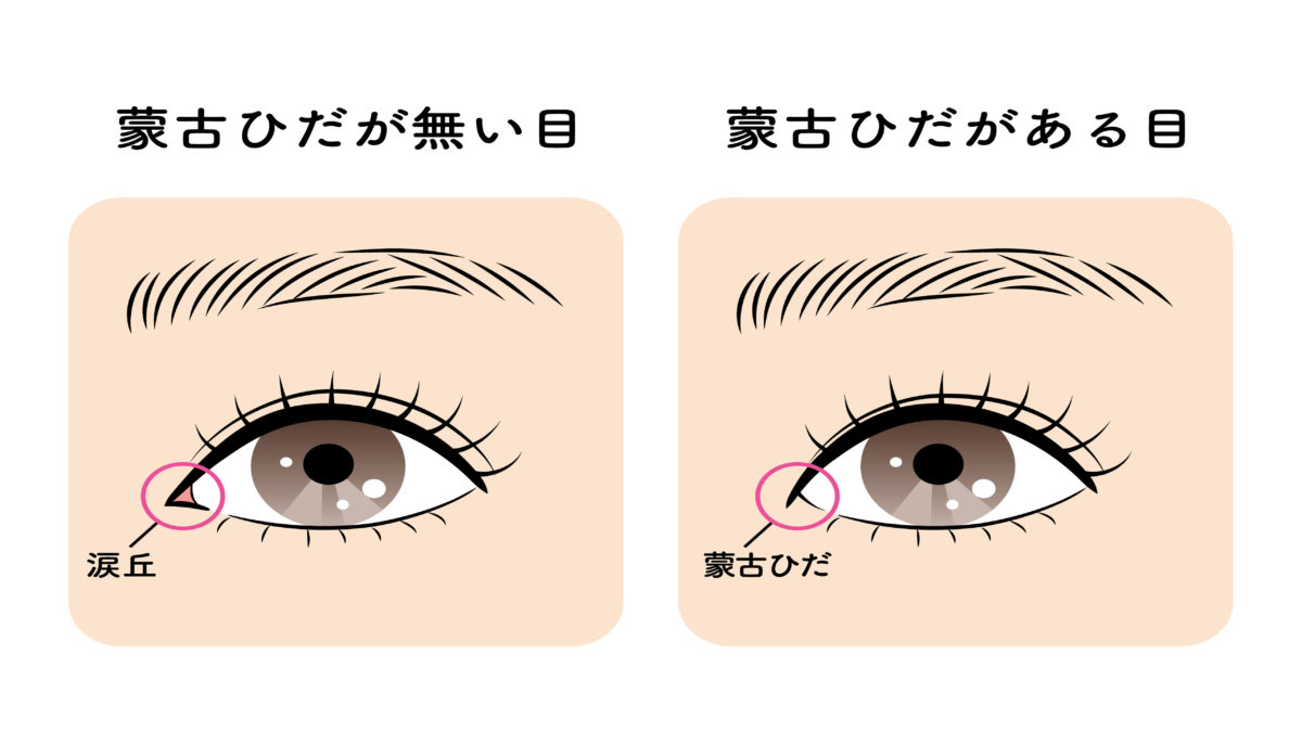 軽度ダウン症に気づかない理由はなぜ？モザイク型の真相と診断実態
