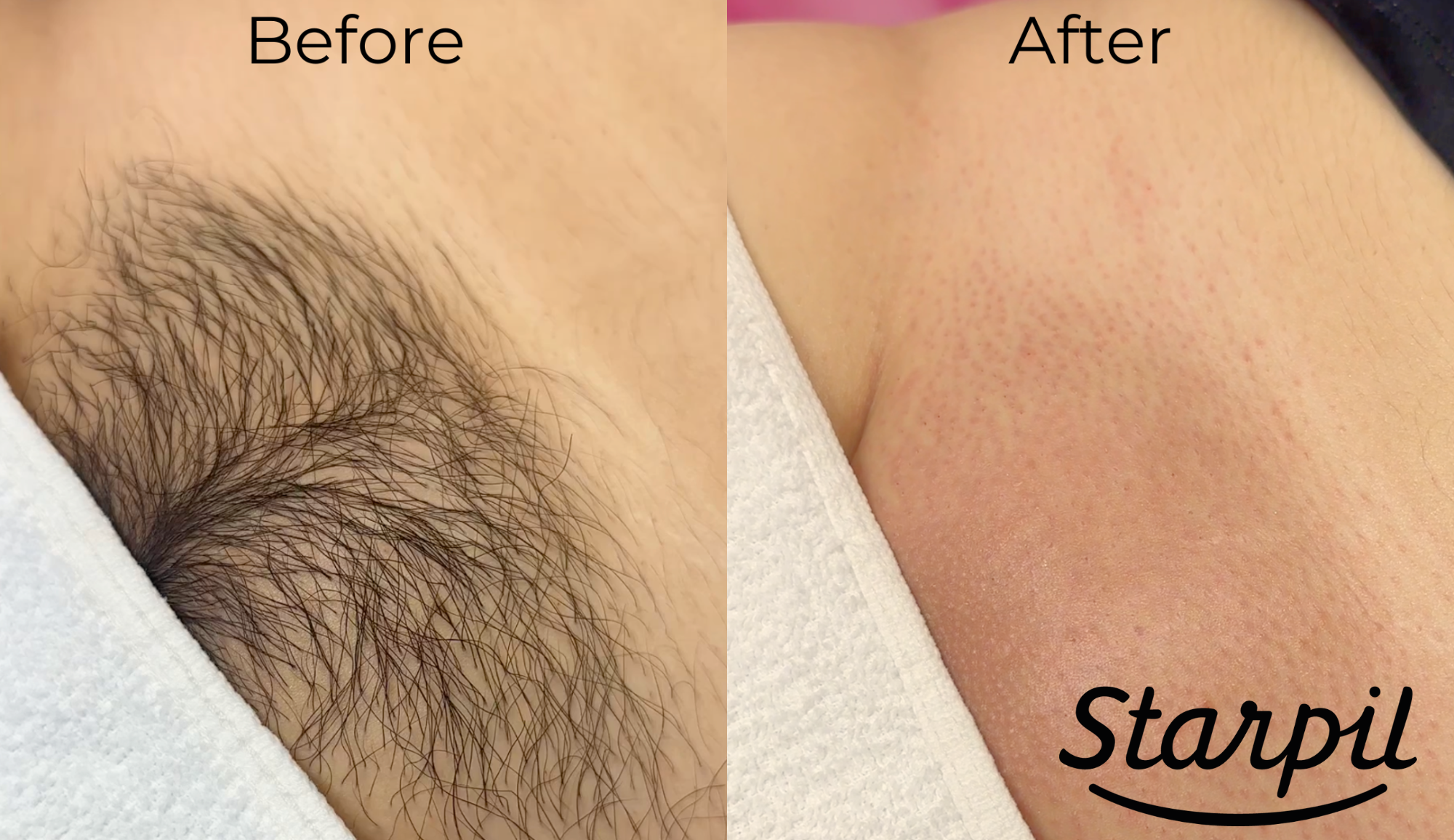 Manzilian Wax Before and After Pictures