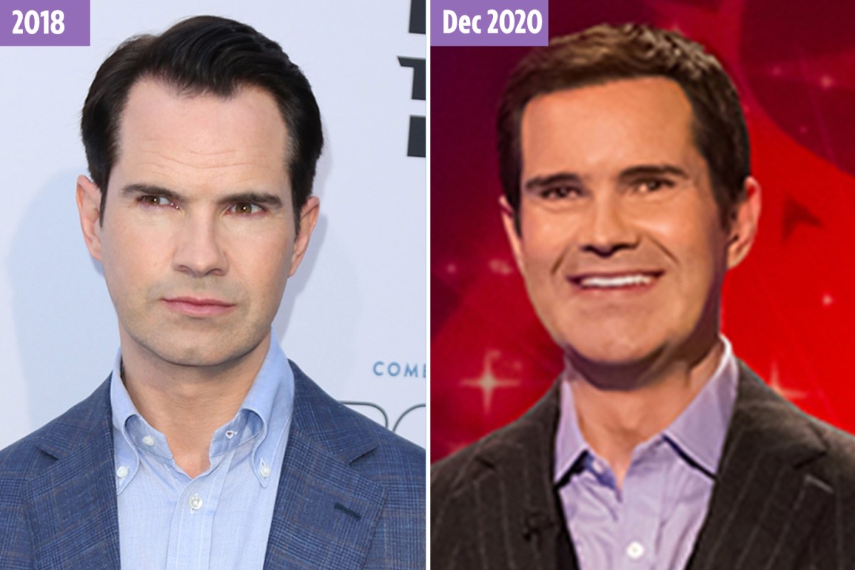 Jimmy Carr Before and After Plastic Surgery