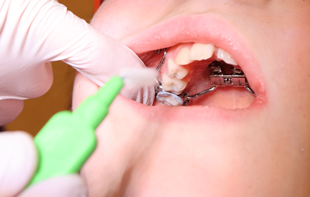 How to Clean Palate
