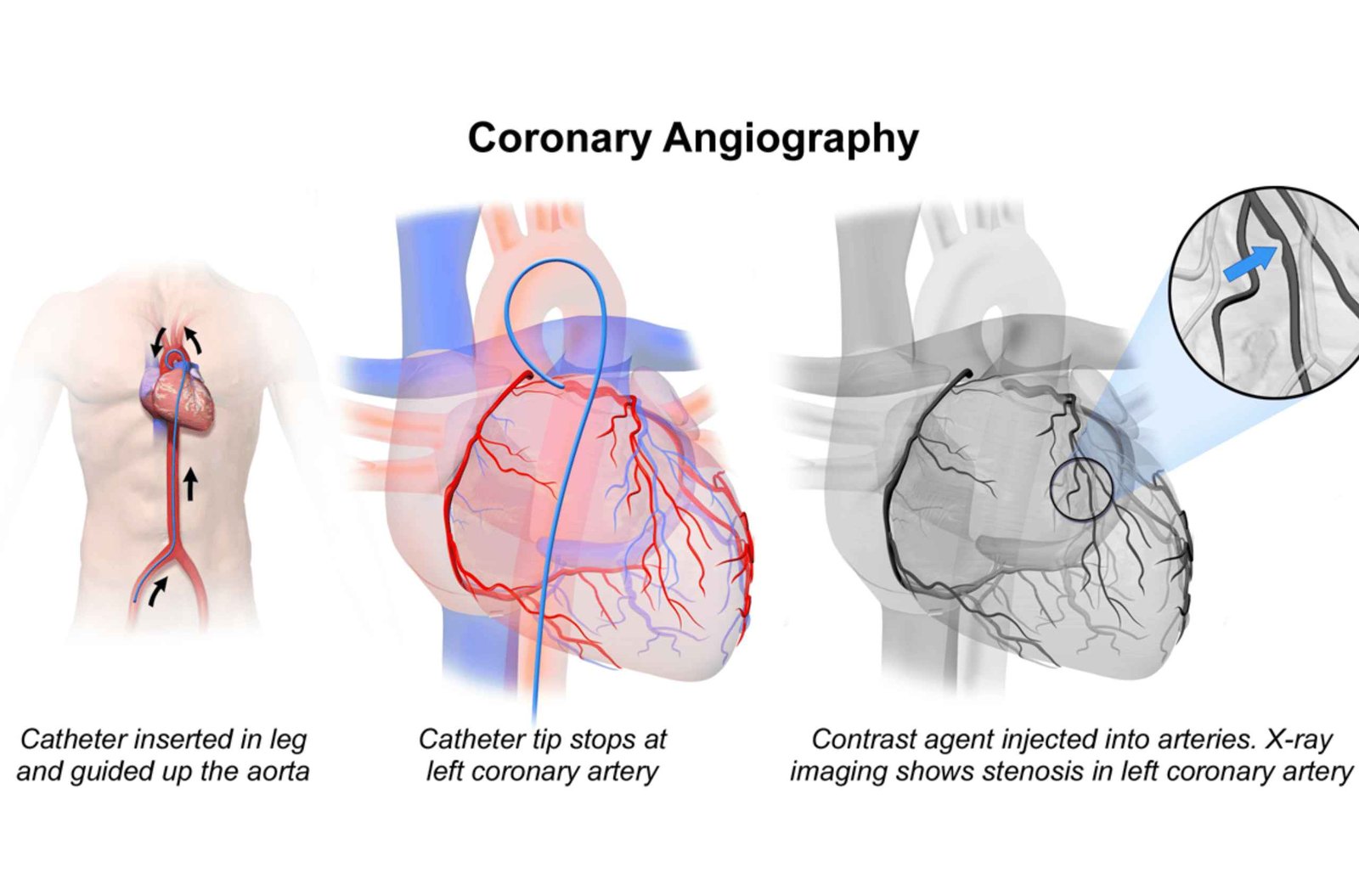 Angio Test for Heart