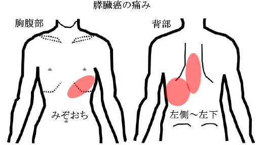 膵臓がんの背中の痛みはどこ？肩甲骨と左側の違和感に潜む重大サイン