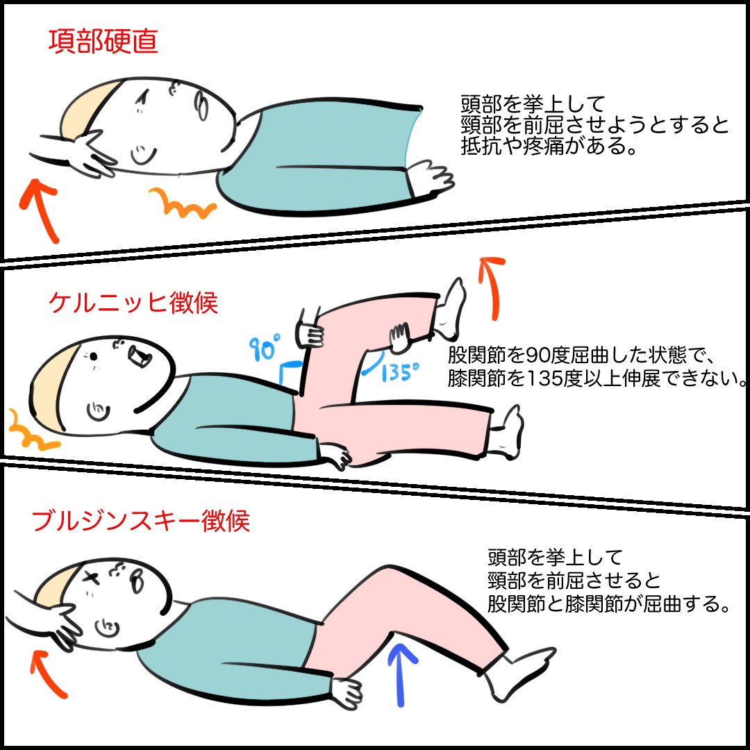 ケルニッヒ徴候とは？髄膜炎を見抜く検査手技と135度の基準を徹底解説