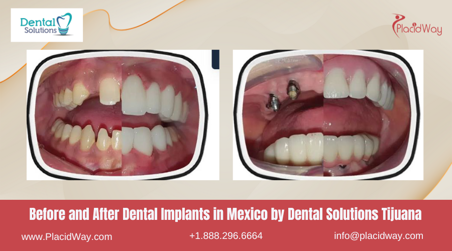 Dental Implants in Mexico