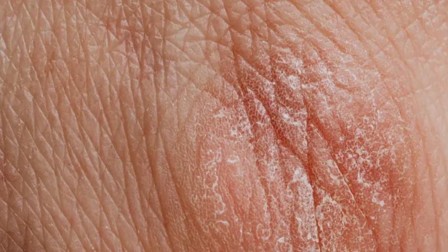 Does Hard Water Cause Dry Skin