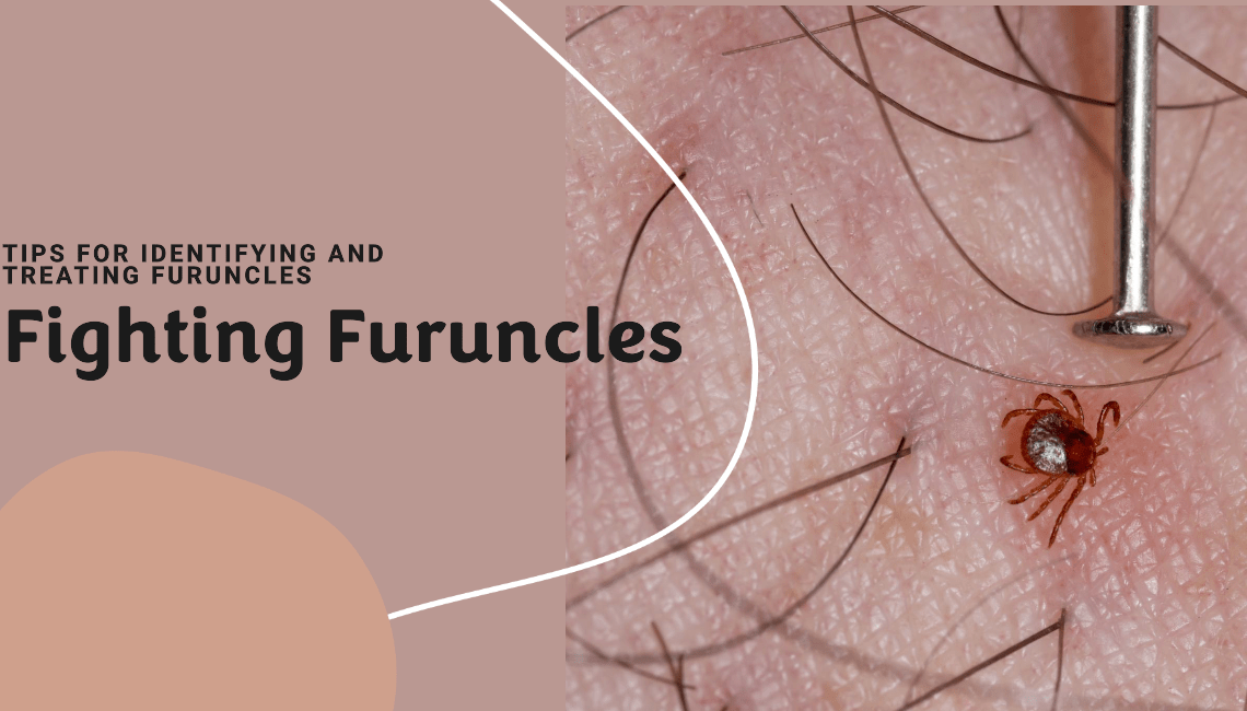 How to Get Rid of Furuncle
