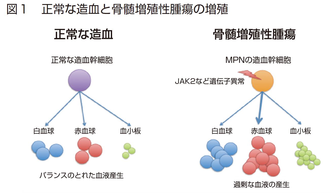 骨髄増殖性腫瘍の真実｜初期症状・余命から2026年最新治療まで徹底解説