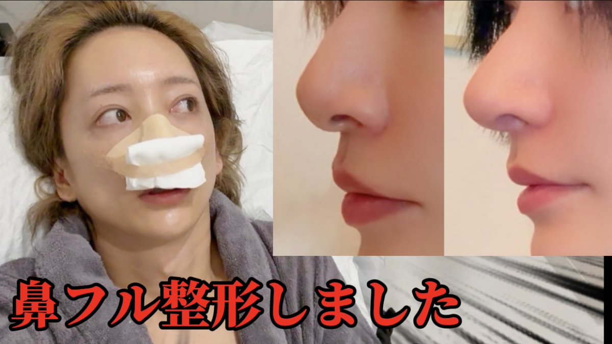 リアルピースこぺの整形前とは？昔の写真とすっぴんから顔の変化を徹底検証