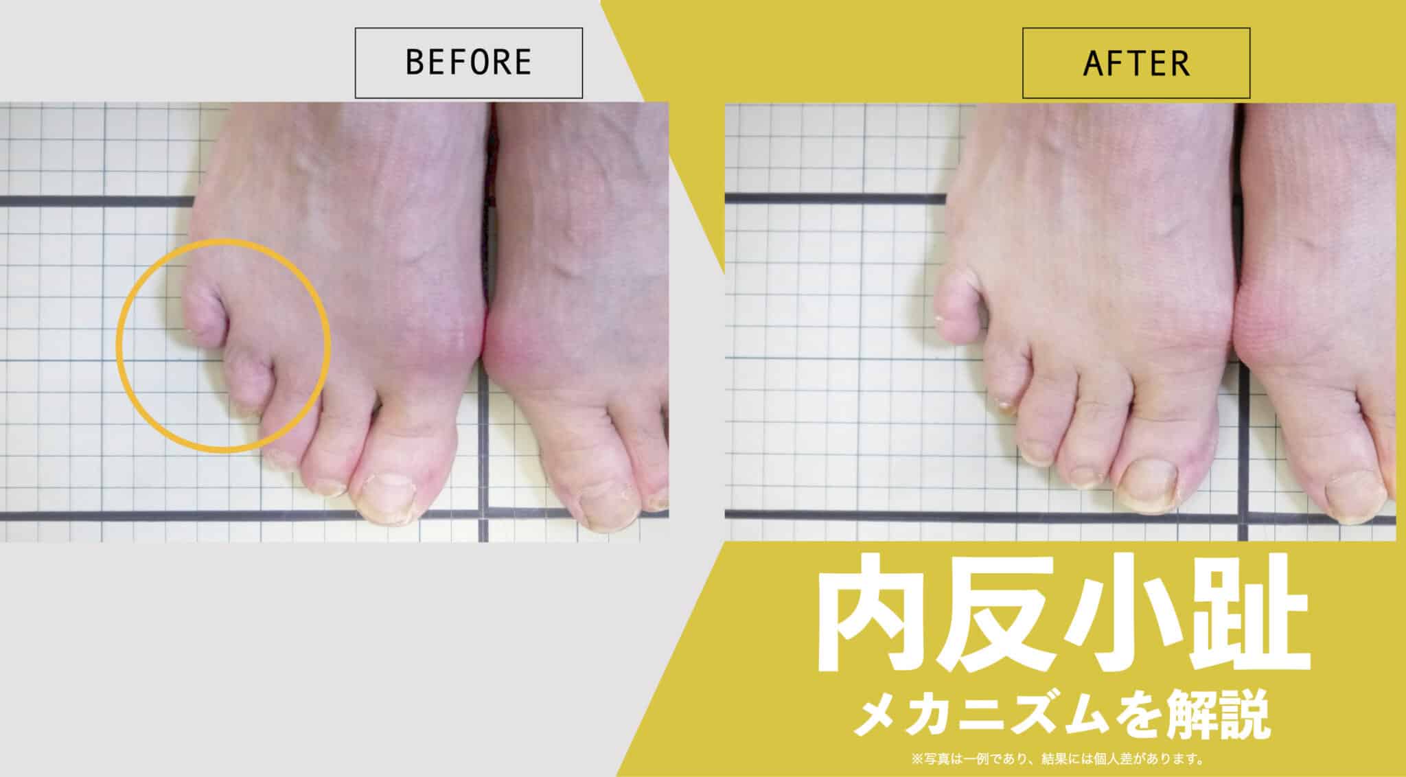足の小指が曲がってる治し方！内反小趾と寝指を自宅で改善する全技術
