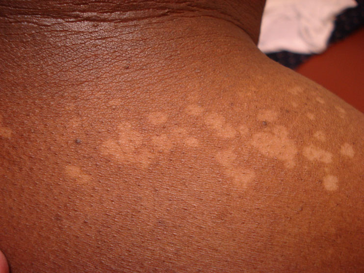 White Spots Dark Skin