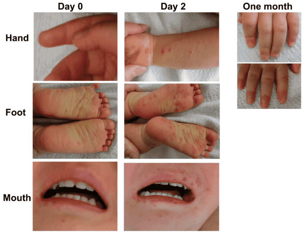 How. Long Does Hand Foot and Mouth Last