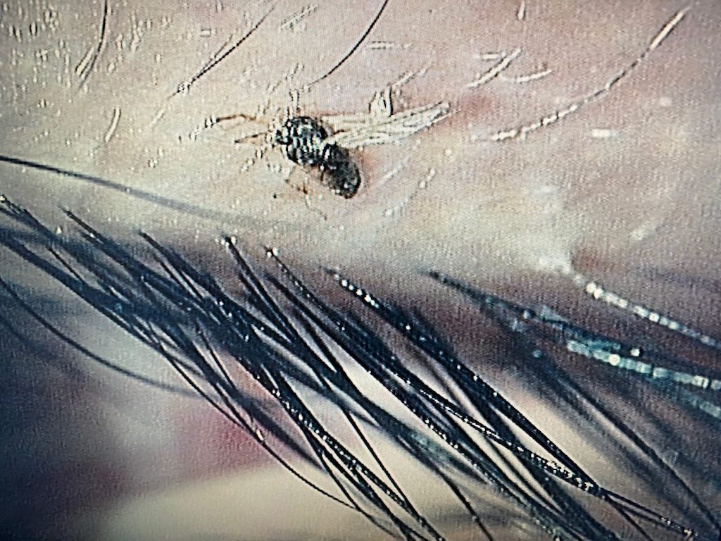 目に虫が入った時の緊急対処法と絶対にやってはいけないNg行動