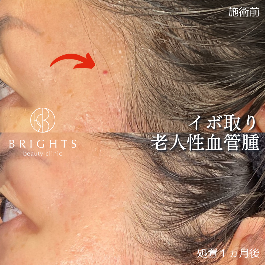 顔のイボ画像と症例比較｜皮膚がんとの見分け方と最新の除去費用2026