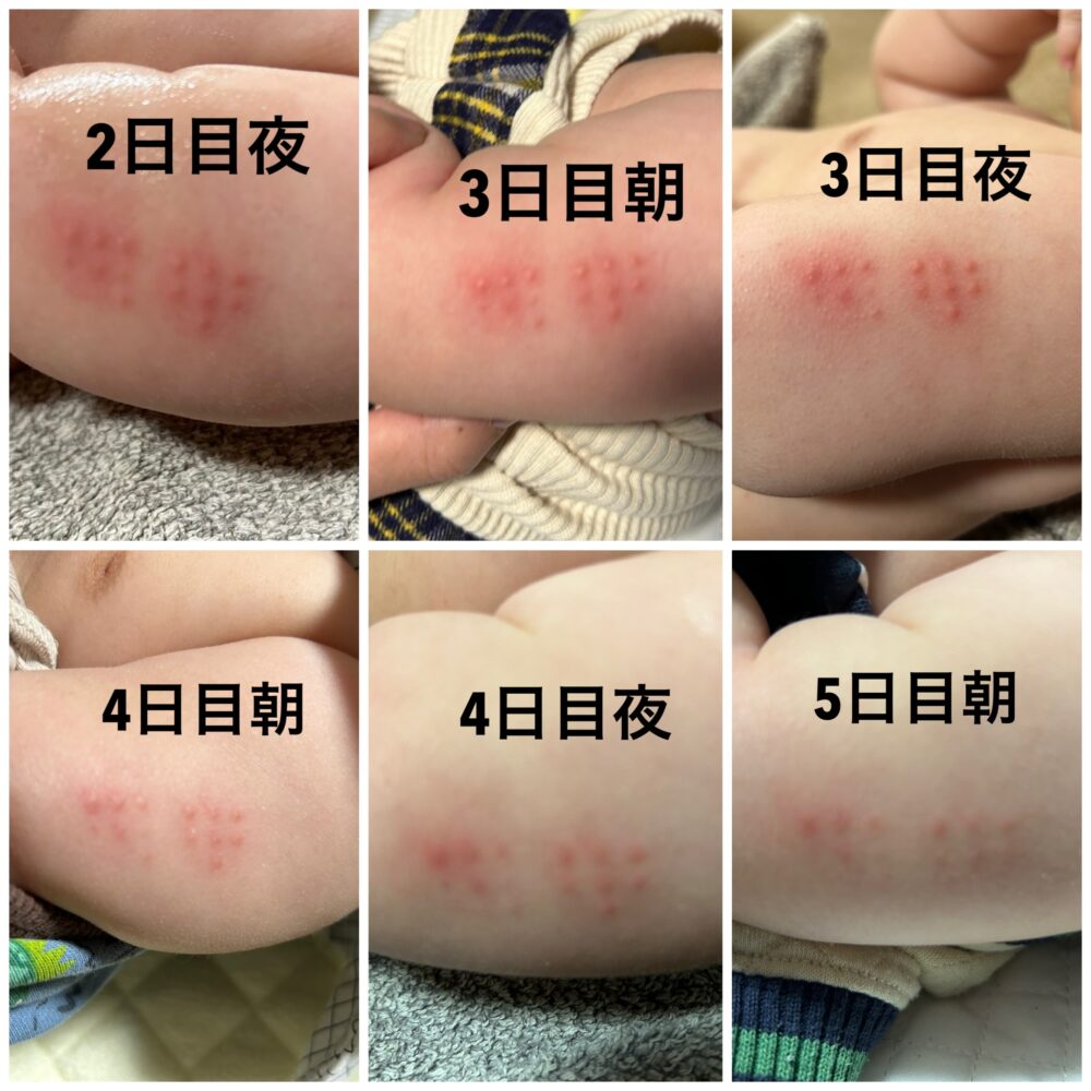 Bcg接種当日のお風呂はいつから？石鹸や洗い方・Ng行動と副反応の見分け方