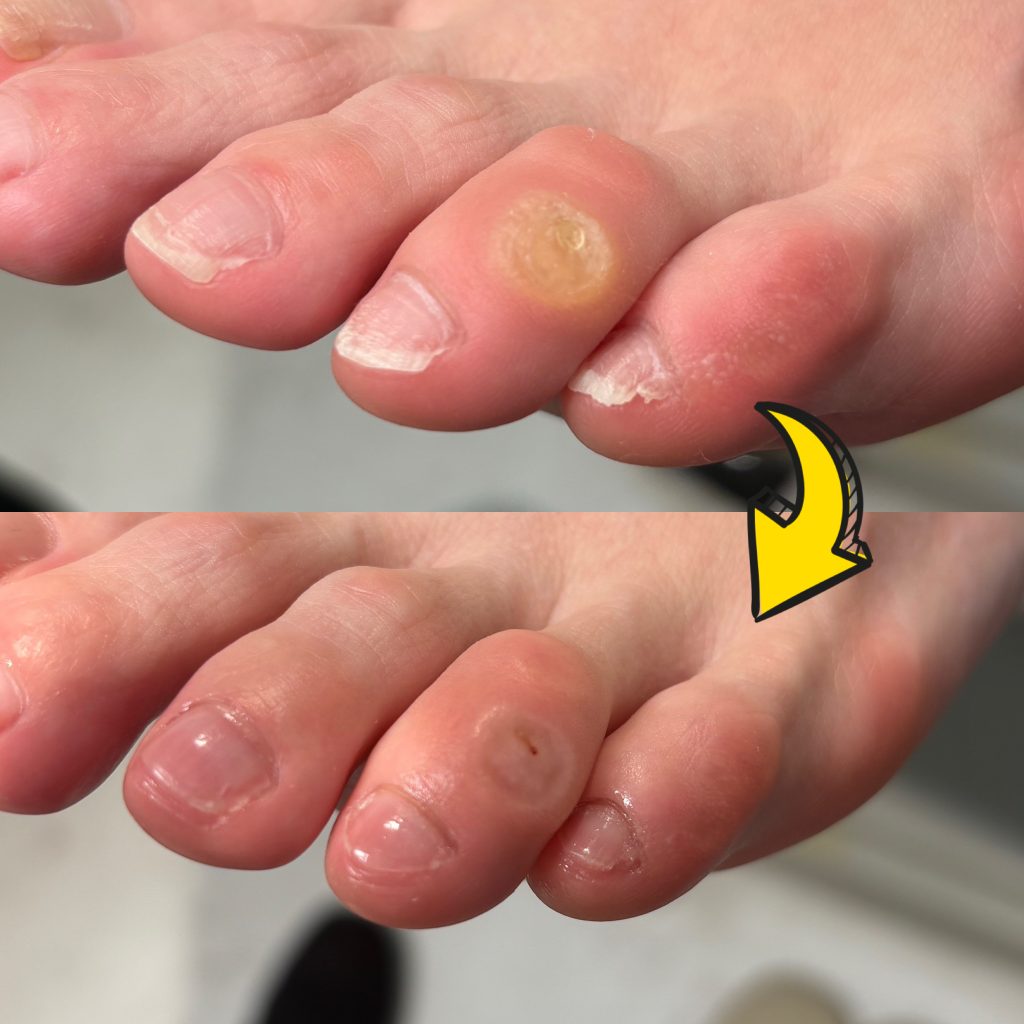 足の爪の角質ケアで激変！巻き爪や悪臭を防ぐプロ直伝の除去保湿法