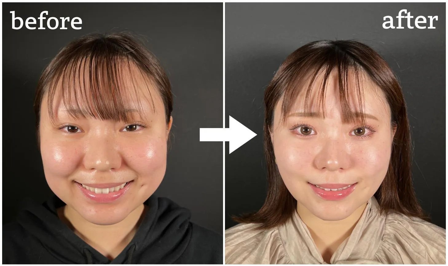 笑った時の頬の肉が盛り上がる真相とは？自力解消法と美容医療の境界線