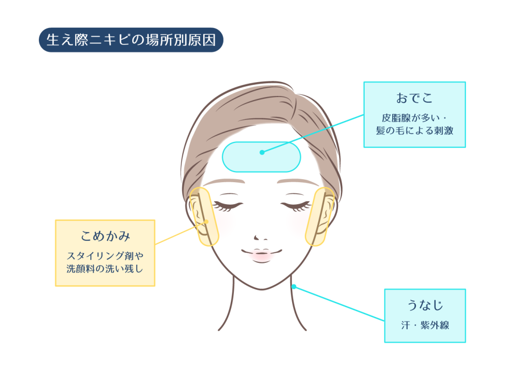 おでこ・生え際ニキビの原因と治し方！前髪やシャンプーの盲点を徹底解明