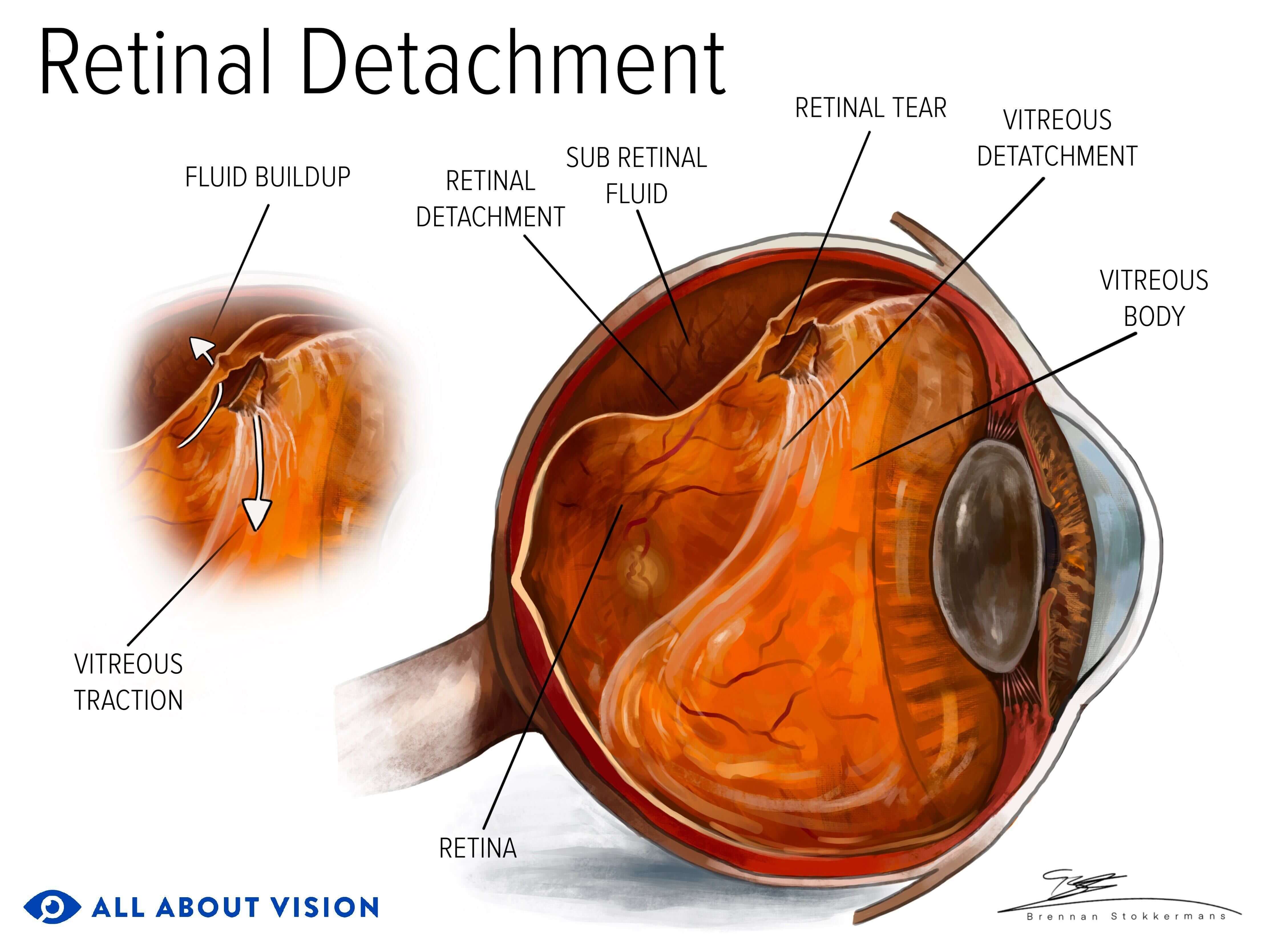 What Does a Detached Retina Feel Like