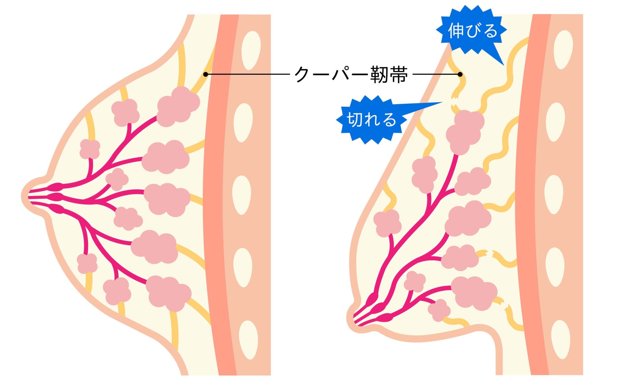 胸のクーパー靭帯は切れたら戻らないって本当？バスト下垂の真相と正しい予防法
