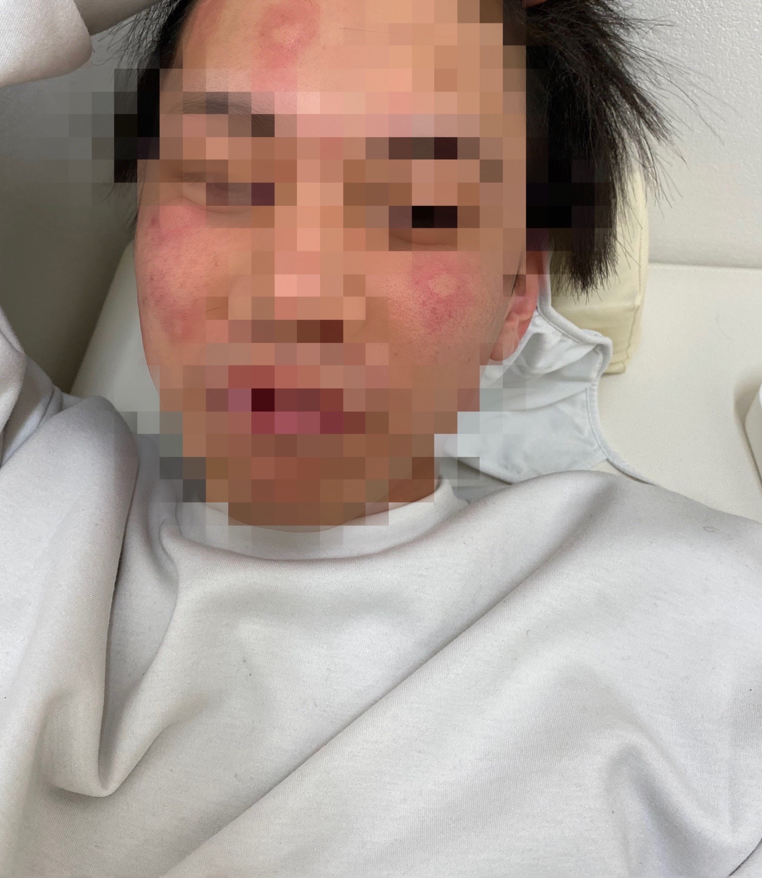 突然の顔の蕁麻疹はなぜ起きる？原因・クインケ浮腫の見極めと応急処置