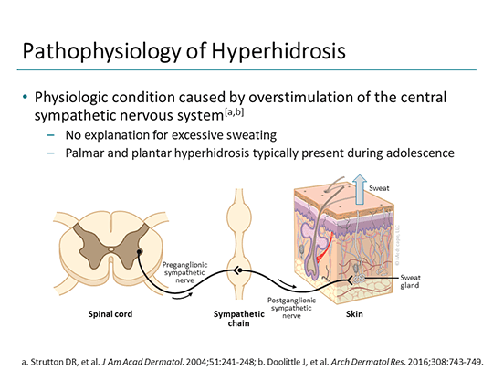Hyperhidrosis Causes: from Nerve Signals to Underlying Conditions