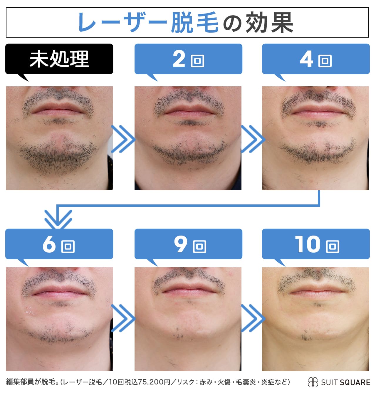 髭脱毛しないほうがいい本当の理由！後悔前に知るべき5つの真実