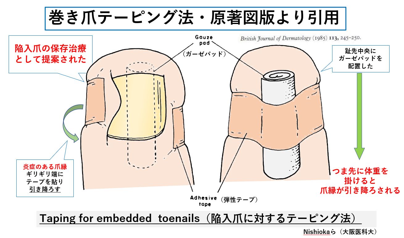 巻き爪テーピングで激痛が消える！正しい貼り方と悪化を防ぐ対処法