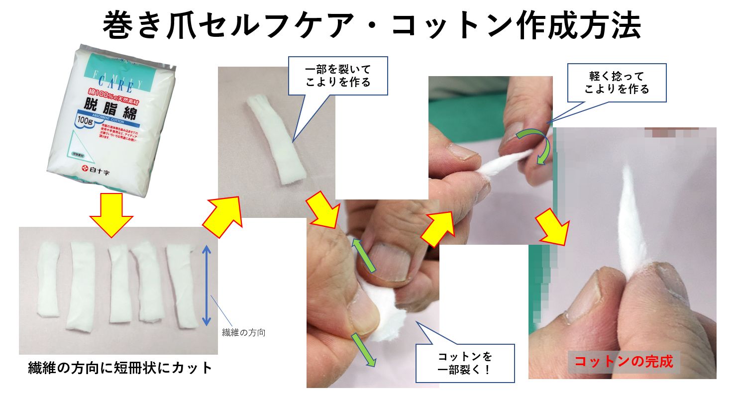 巻き爪コットン療法の真実！正しい詰め方と悪化防ぐ絶対条件