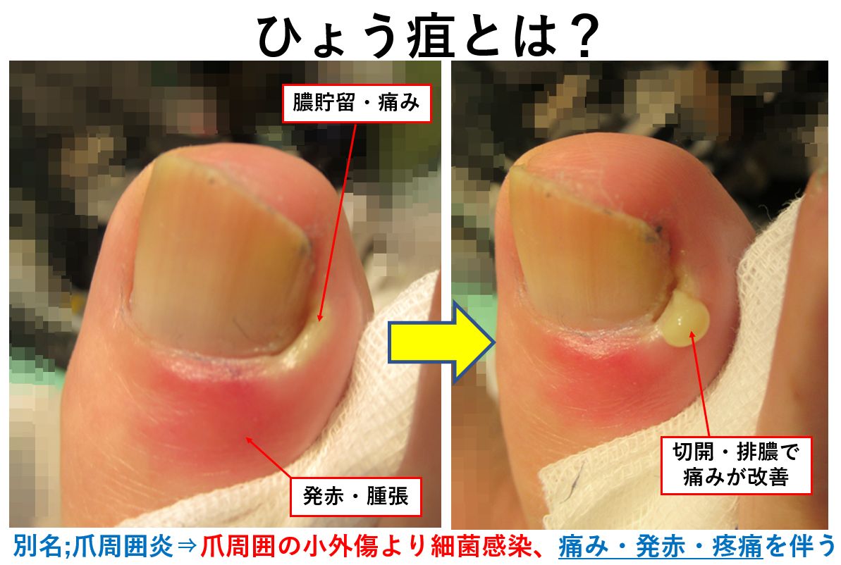 指先のズキズキは爪周囲炎？自然治癒の限界と悪化を防ぐ治し方ガイド