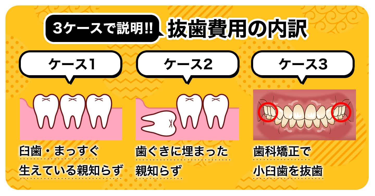親知らず2本抜歯の費用総額はいくら？保険適用の相場と生え方別の差